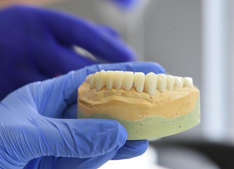 Dental Implants